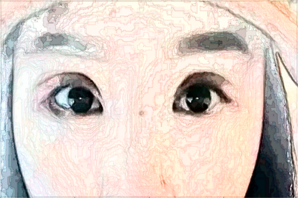 浙江省中醫(yī)院填淚溝做的好不好_填淚溝多長時間恢復(fù)好