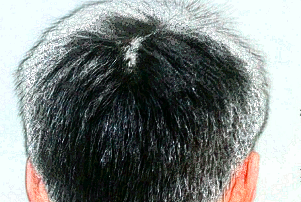 上海東方醫(yī)院植發(fā)做的好嗎_案例+價格