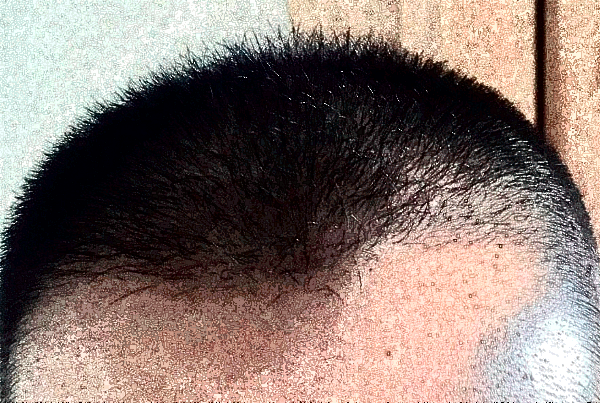 上海東方醫(yī)院植發(fā)做的好嗎_案例+價格