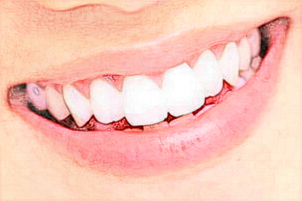 2024河北醫(yī)科大學(xué)口腔醫(yī)院種植牙價目表(價格表)怎么樣