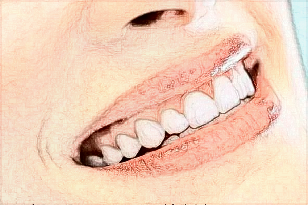 2024四川大學華西口腔醫(yī)院種植牙價格多少?種植牙案例分享