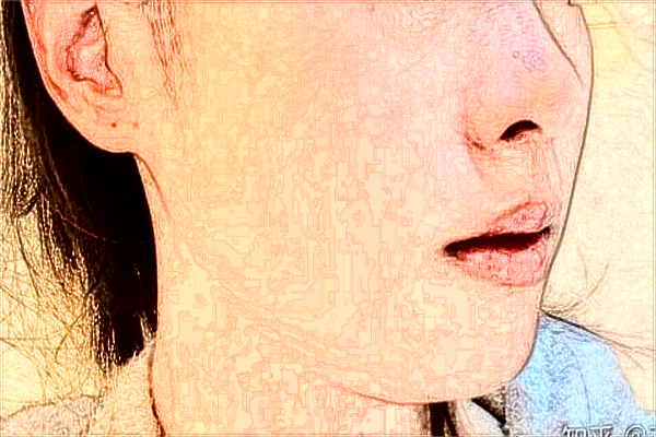 大連醫(yī)科大學附屬第一醫(yī)院激光去紅血絲做的好嗎_案例價格分享