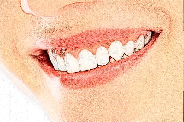 2024重慶醫(yī)科大學(xué)附屬口腔醫(yī)院牙齒美白需要多少錢_案例分享