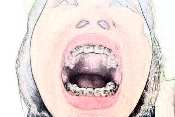 2024重慶醫(yī)科大學附屬口腔醫(yī)院做的全瓷冠怎么樣【全瓷冠案例】