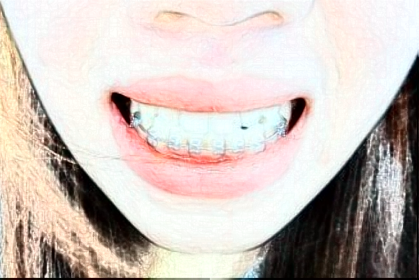 重慶醫(yī)科大學(xué)附屬口腔醫(yī)院烤瓷牙怎么樣_哪個(gè)醫(yī)生比較有名氣