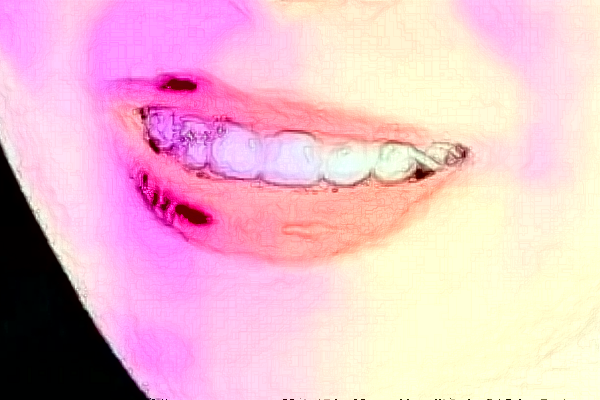 重慶醫(yī)科大學(xué)附屬口腔醫(yī)院拔智齒價(jià)目表(價(jià)格表)怎么樣