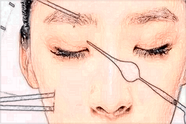 2024昆明市第一人民醫(yī)院光子嫩膚多少錢?光子嫩膚副作用