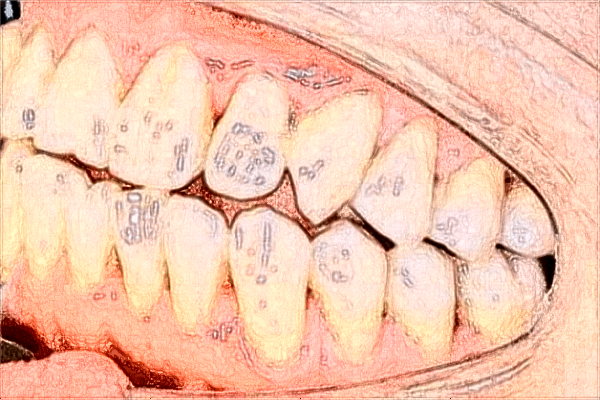 昆明市第—人民醫(yī)院補(bǔ)牙好不好?2024補(bǔ)牙貴嗎?