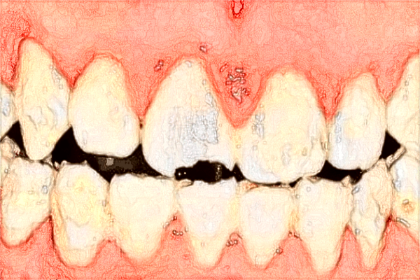 昆明市第一人民醫(yī)院矯正牙齒好不好?矯正牙齒貴嗎