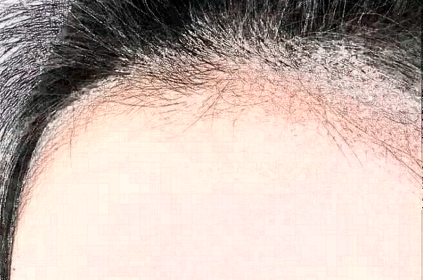 　　發(fā)際線不好看、大量脫發(fā)導(dǎo)致禿頂?shù)那闆r等，會(huì)給朋友們帶來(lái)很大的煩惱，這種情況可以選擇植發(fā)手術(shù)來(lái)，大連醫(yī)科大學(xué)附屬第一醫(yī)院做植發(fā)的技術(shù)比較不錯(cuò)，根據(jù)大連地區(qū)網(wǎng)絡(luò)檢索的結(jié)果，比較常見(jiàn)的是發(fā)際線價(jià)格一般會(huì)在1100-38000元左右不等，比較常見(jiàn)的頭頂加密植發(fā)價(jià)格一般會(huì)在900-9300元左右不等，以上給出的價(jià)格僅供于參考，具體詳細(xì)的價(jià)格還需要到醫(yī)院找醫(yī)生進(jìn)行面診之后來(lái)獲取。  　　1、2024大連醫(yī)科大學(xué)附屬第一醫(yī)院植發(fā)案例  　　很多年前自己一直脫頭發(fā)，其實(shí)這也屬于正常的反應(yīng)，因?yàn)轭^發(fā)都會(huì)有一個(gè)新陳代謝，隨著時(shí)間的增加，自己的頭發(fā)脫的有點(diǎn)多，每一次洗頭發(fā)的時(shí)候都掉一大把，當(dāng)時(shí)也沒(méi)有太在意，一次無(wú)意間發(fā)現(xiàn)了自己頭頂?shù)念^發(fā)有一些稀少，這才意識(shí)到了脫發(fā)的嚴(yán)重性，所以想通過(guò)植發(fā)手術(shù)來(lái)，在家人的陪同下來(lái)到了大連醫(yī)科大學(xué)附屬第一醫(yī)院，跟醫(yī)生說(shuō)明了自己掉發(fā)的情況，并且問(wèn)了醫(yī)生能不能做植發(fā)手術(shù)，醫(yī)生采取診斷之后建議說(shuō)可以做植發(fā)手術(shù)，所以配合了醫(yī)生的工作，整體手術(shù)操作大概用了不到三個(gè)小時(shí)左右的時(shí)間，術(shù)后就能夠看到一些植發(fā)的痕跡，在半個(gè)月之后直的頭發(fā)慢慢的長(zhǎng)了出來(lái)，看到長(zhǎng)出來(lái)的頭發(fā)自己的心情也愉悅了很多，終于不用擔(dān)心頭發(fā)稀少的問(wèn)題帶來(lái)的困擾了。  　　2、2024大連醫(yī)科大學(xué)附屬第一醫(yī)院簡(jiǎn)介  　　大連醫(yī)科大學(xué)附屬第一醫(yī)院整形美容科是一個(gè)集醫(yī)療、教學(xué)、科研、預(yù)防為一體的大型綜合性醫(yī)院，醫(yī)院包括有美容外科、整形外科、頜面美容外科、皮膚激光美容外科等，醫(yī)院開(kāi)展的手術(shù)項(xiàng)目有先天性和創(chuàng)傷性的畸形修復(fù)、除皺、乳房整形、減肥、面部年輕化抗衰老、植發(fā)、手術(shù)、手術(shù)等多個(gè)項(xiàng)目，醫(yī)院多年的發(fā)展結(jié)合了先進(jìn)的技術(shù)和設(shè)備儀器，建立了一個(gè)重大特色的項(xiàng)目合作單位，并定期會(huì)派專業(yè)的醫(yī)護(hù)人員進(jìn)行整形美容技術(shù)學(xué)術(shù)交流和研討，為廣大女性朋友在求美的道路上制定個(gè)性化的醫(yī)美服務(wù)，醫(yī)院內(nèi)的醫(yī)生都有著先手的操作手法，組建了一支技術(shù)精湛的醫(yī)生團(tuán)隊(duì)，會(huì)為女性朋友在秋美的道路上所需求，進(jìn)行個(gè)性化的設(shè)計(jì)和診斷，得到了很多朋友們的一致好評(píng)。