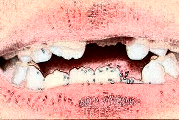 河北醫(yī)科大學(xué)口腔醫(yī)院牙齒修復(fù)價(jià)格多少?牙齒修復(fù)案例分享