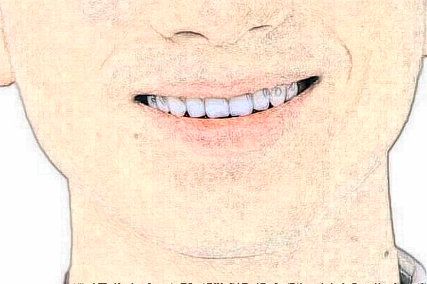 重慶醫(yī)科大學(xué)附屬口腔醫(yī)院做根管怎么樣_案例+價格