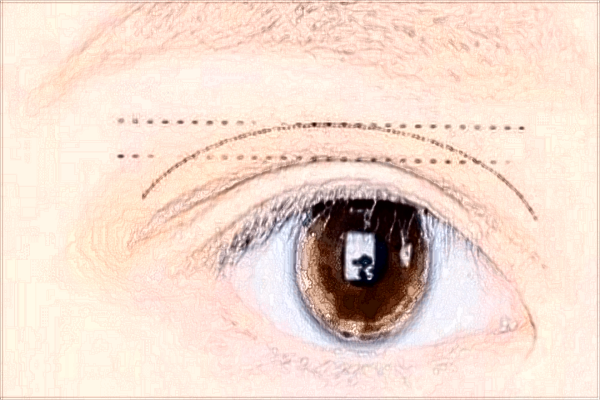 南昌大學第一附屬醫(yī)院近視眼激光手術費用?有后遺癥嗎