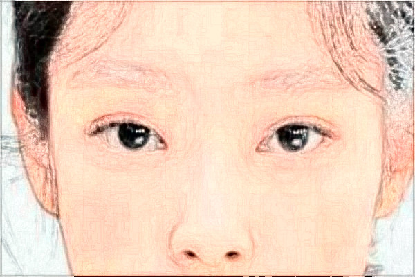 金華市中心醫(yī)院半飛秒做的好嗎_案例+價格