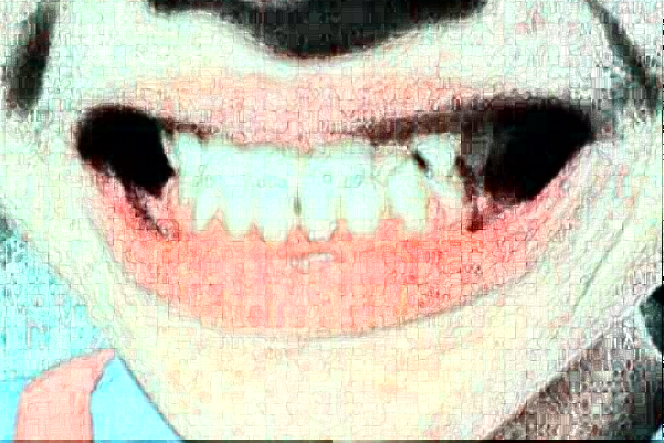 四川大學華西口腔醫(yī)院鑲牙做的怎么樣_哪個醫(yī)生做的比較好