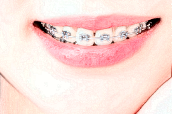 2024阜陽(yáng)市人民醫(yī)院牙齒矯正做的好嗎_誰(shuí)做的比較好