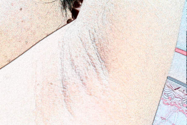 徐州市中心醫(yī)院去狐臭怎么樣_價(jià)格+案例分享