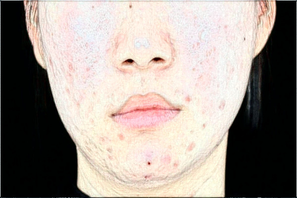 哈爾濱醫(yī)科大學附屬第一醫(yī)院去疤做的好嗎_案例+價格