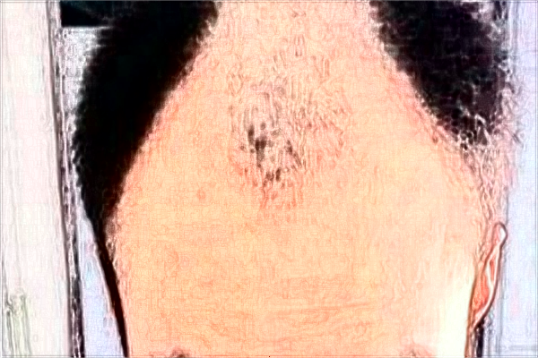 2024中山大學附屬第一醫(yī)院植發(fā)多少錢?植發(fā)好嗎