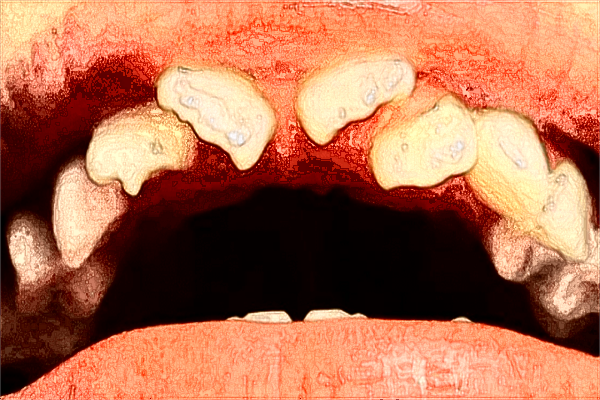 中山大學(xué)附屬第一醫(yī)院牙科矯正好嗎?2024牙科矯正費(fèi)用多少