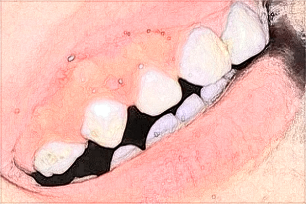 中山大學(xué)附屬第一醫(yī)院牙科哪個(gè)醫(yī)生好?牙齒矯正好嗎