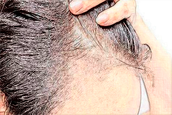 中山大學(xué)附屬第一醫(yī)院植發(fā)怎么樣?2024植發(fā)價(jià)格