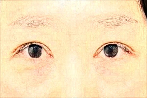 2024徐州市中心醫(yī)院激光消除黑眼圈做的好嗎？體驗(yàn)案例分享