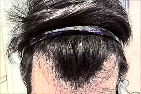 2024天津人民醫(yī)院植發(fā)價目表(價格表)_口碑怎么樣