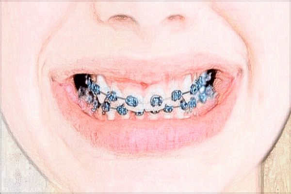 2024珠海市人民醫(yī)院牙科價(jià)目表?牙齒矯正多少錢