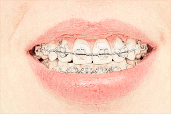 2024珠海市人民醫(yī)院牙科價(jià)目表?牙齒矯正多少錢