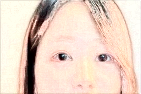 2024阜陽市人民醫(yī)院去眼袋怎么樣_案例分享