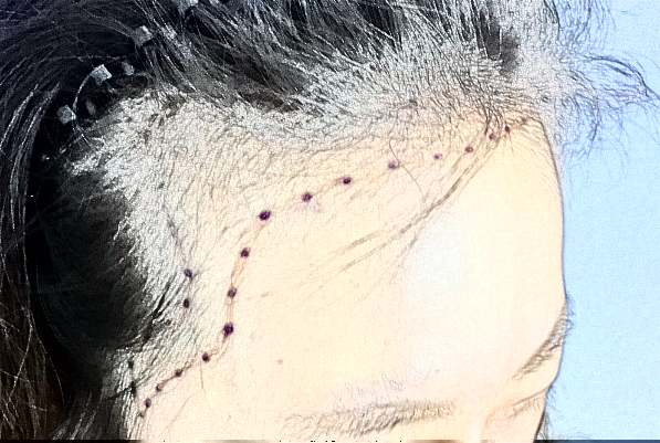 2024臺州醫(yī)院植發(fā)怎么樣_哪位醫(yī)生技術(shù)比較不錯(cuò)