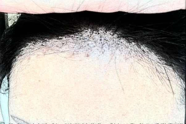 2024臺州醫(yī)院植發(fā)怎么樣_哪位醫(yī)生技術(shù)比較不錯(cuò)