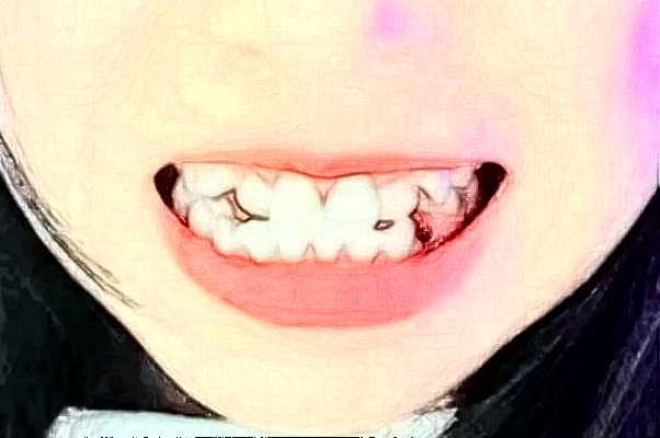 2024蘇州第四人民醫(yī)院烤瓷牙怎么樣【案例日記分享】