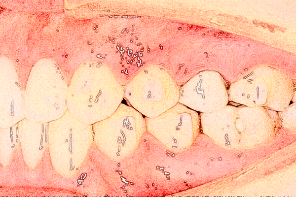 江蘇大學附屬醫(yī)院口腔科牙齒種植怎么樣_哪個醫(yī)生比較好
