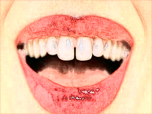 2024中山大學(xué)附屬口腔醫(yī)院洗牙收費(fèi)標(biāo)準(zhǔn)?洗牙能讓牙變白?