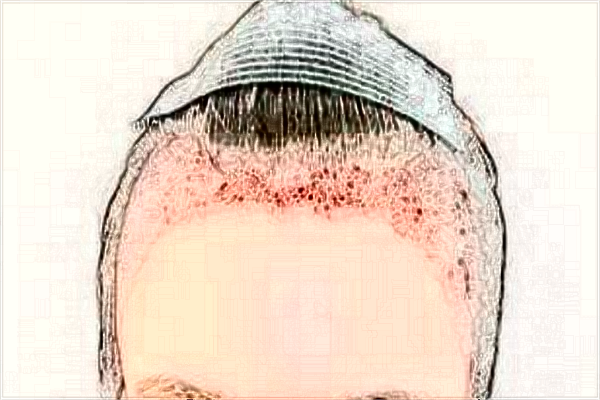 2024杭州市第一人民醫(yī)院植發(fā)怎么樣_哪位醫(yī)生做的好