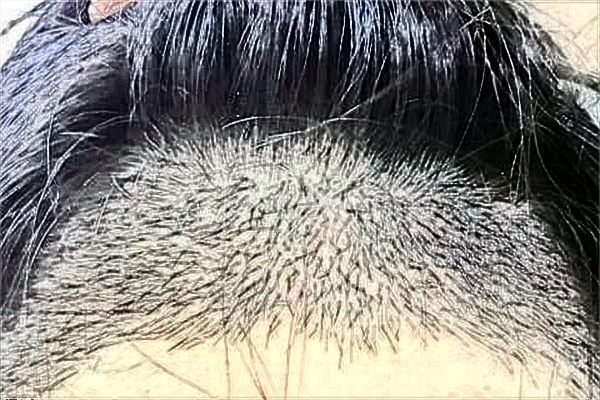 江蘇大學(xué)附屬醫(yī)院植發(fā)怎么樣_哪個醫(yī)生比較好