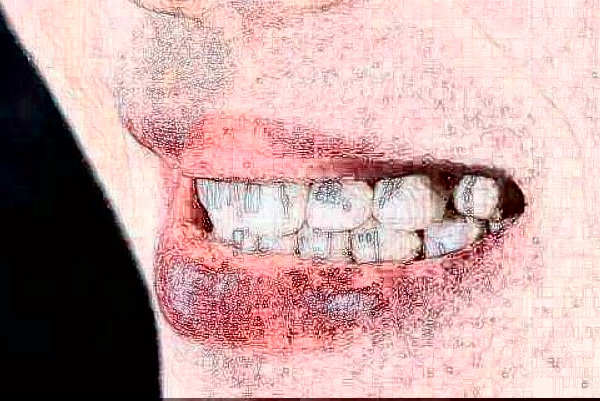 天津醫(yī)科大學第二醫(yī)院口腔科義齒修復價目表(價格表)怎么樣