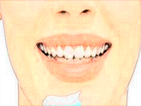 2024中山大學(xué)附屬口腔醫(yī)院牙齒美白價(jià)格?牙齒美白原理