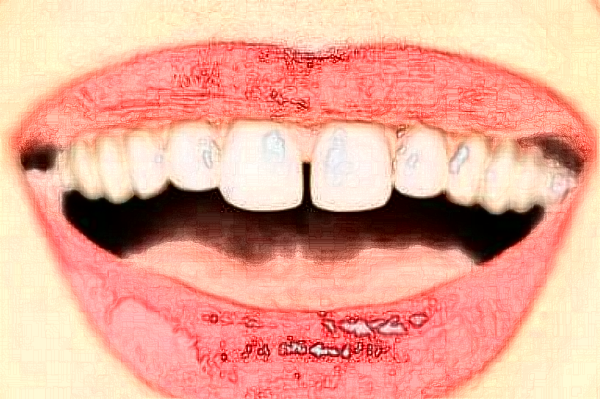 天津醫(yī)科大學(xué)第二醫(yī)院口腔科拔智齒大概多少錢?實(shí)測案例分享