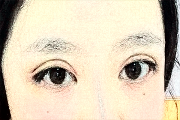 溫州醫(yī)學(xué)院附屬第一醫(yī)院做雙眼皮怎么樣_大概需要多少錢(qián)