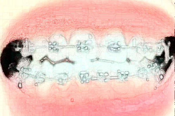 蘇州第四人民醫(yī)院正畸價(jià)目表(價(jià)格表)怎么樣