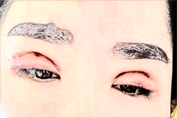 上海東方醫(yī)院割雙眼皮那個(gè)醫(yī)生做的好【雙眼皮案例】