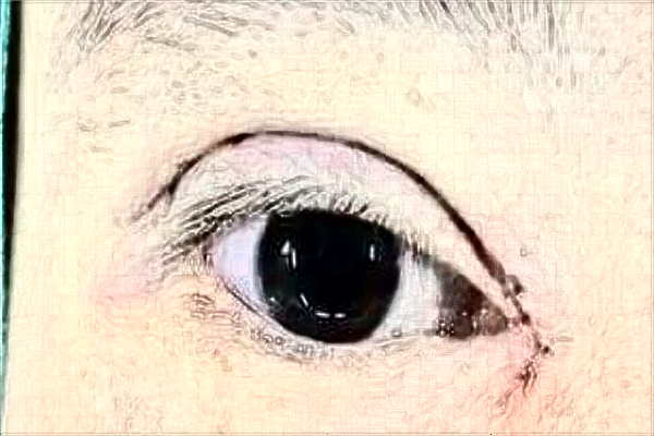 上海東方醫(yī)院割雙眼皮那個(gè)醫(yī)生做的好【雙眼皮案例】