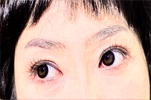 2024哈爾濱醫(yī)科大學(xué)附屬第一醫(yī)院做雙眼皮做的好嗎_雙眼皮整形日記分享