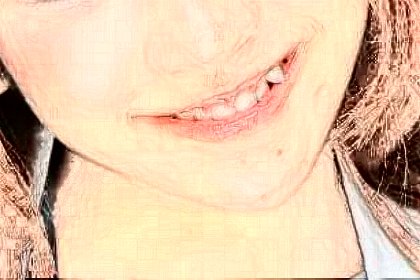 2024安徽省立醫(yī)院牙齒樹(shù)脂修補(bǔ)價(jià)格多少?貴不貴