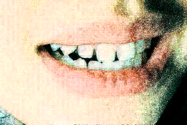 天津醫(yī)科大學(xué)第二醫(yī)院口腔科烤瓷冠怎么樣_哪個醫(yī)生比較好