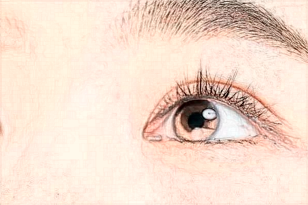 2024青島市立醫(yī)院埋線雙眼皮價(jià)格?埋線雙眼皮的危害性