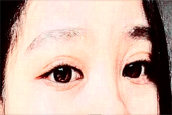 2024安徽省立醫(yī)院全飛秒激光多少錢？誰做得好